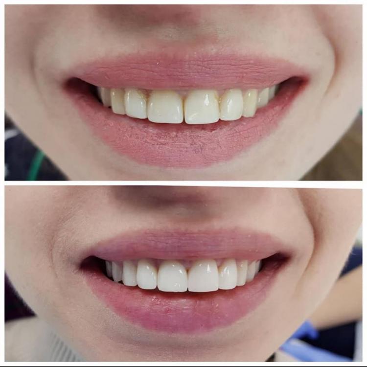 Aesthetic dental reconstruction in Chisinau — 1