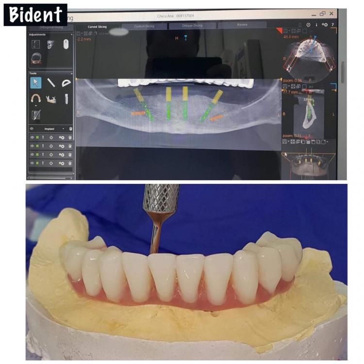 All-on-4 Dental Implants in Chisinau — 1