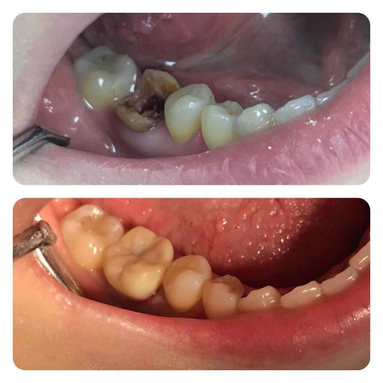 Cavity treatment in Chisinau — 1