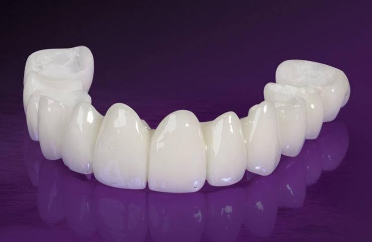 Zirconia dental crowns in Chisinau — 1