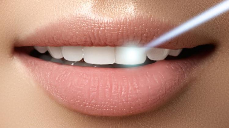 Professional teeth whitening in Chisinau — 1