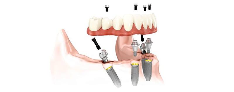 Fixed teeth / All-on-4 restoration