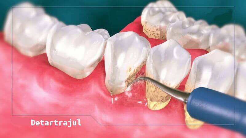 Ultrasonic scaling & Air Flow cleaning